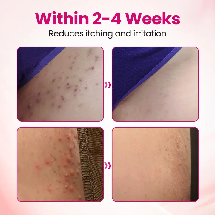 Timilk® IntiDefend Anti-HPV Interferon Gel✅ Blocks High-Risk HPV · Repairs Cervical Tissue · Supports HPV-Negative Results