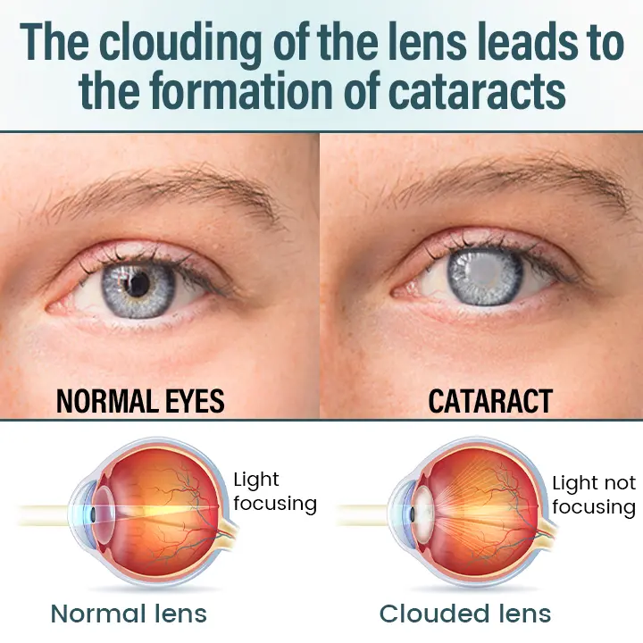 Timilk® OptiFusion Nano Eye Drops Serum —Nano Technology Restores Clear Vision, No Glasses, No Surgery