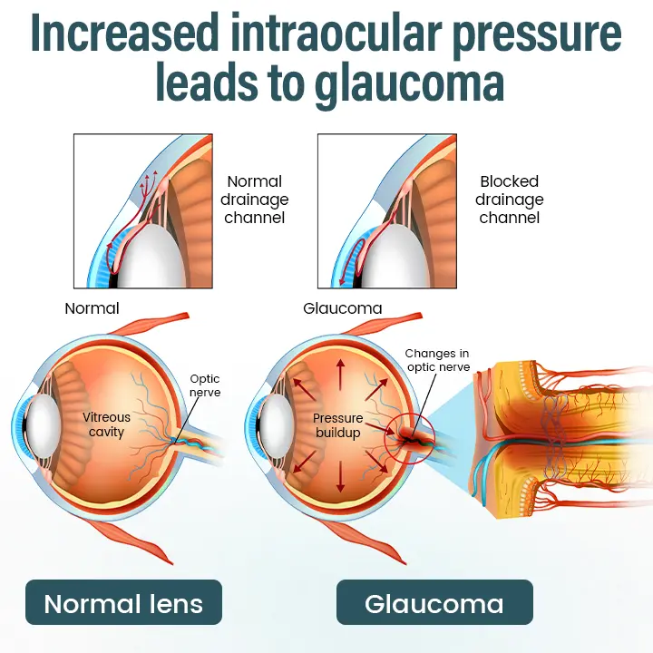 Timilk® OptiFusion Nano Eye Drops Serum —Nano Technology Restores Clear Vision, No Glasses, No Surgery