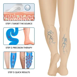 Timilk® VeinFlow Microneedle Repair Patch
