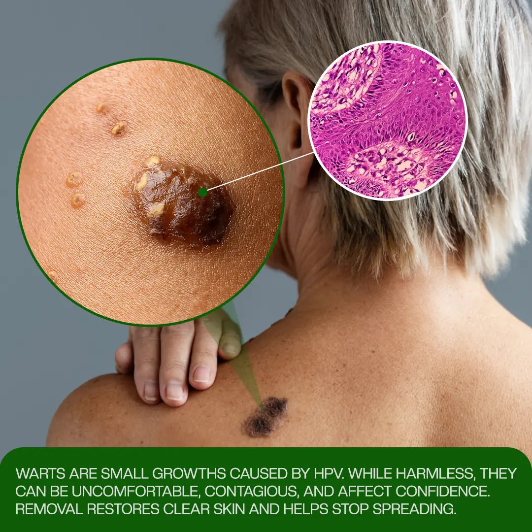 Timilk® ClinixClear Wart Remover Patch