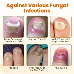 Timilk® FungiBee Advanced Nail Repair Spray