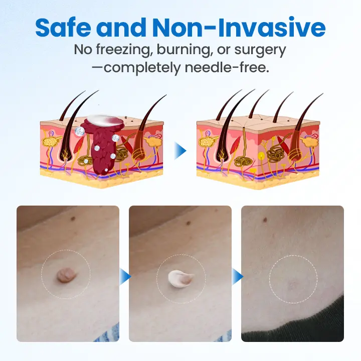 Timilk® TagGone Wart Removal Cream 🔥