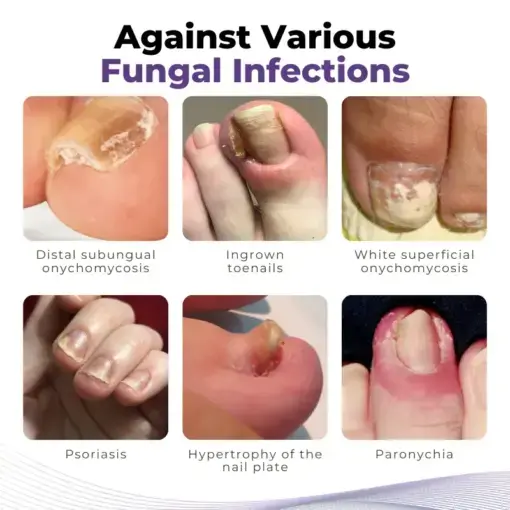 Timilk® MycoOut Natural Nail Fungus Solution
