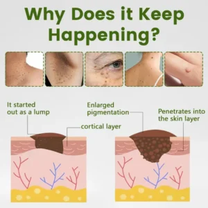 Timilk® ThujaClear Botanical Wart Cream (A)