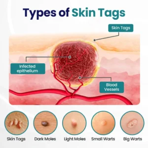 Timilk® WartLift Corn Removal Liquid (new)